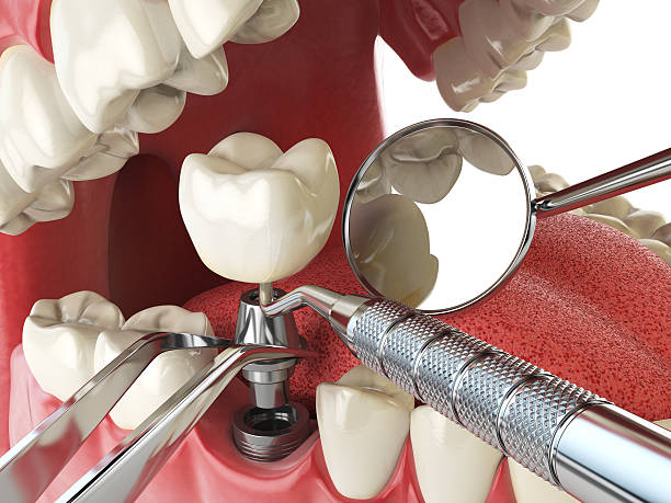 Best Emergency Treatment for Dental Infections or Abscesses in Yaeyville, NC